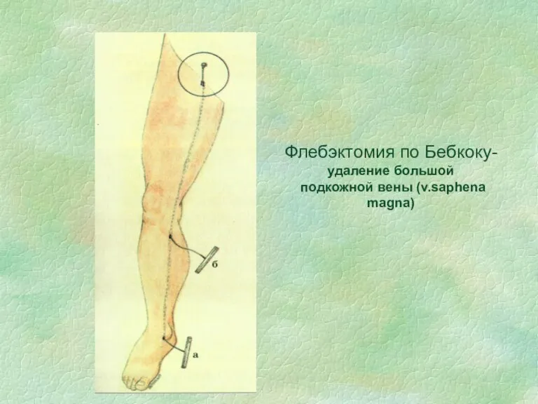 Флебэктомия по Бебкоку- удаление большой подкожной вены (v.saphena magna)