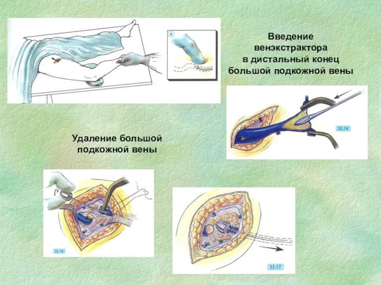 Удаление большой подкожной вены Введение венэкстрактора в дистальный конец большой подкожной вены