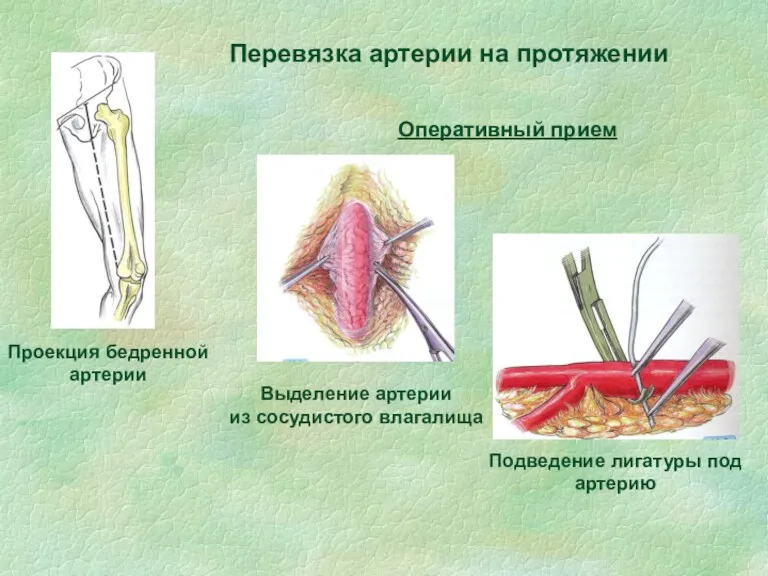 Перевязка артерии на протяжении Проекция бедренной артерии Выделение артерии из