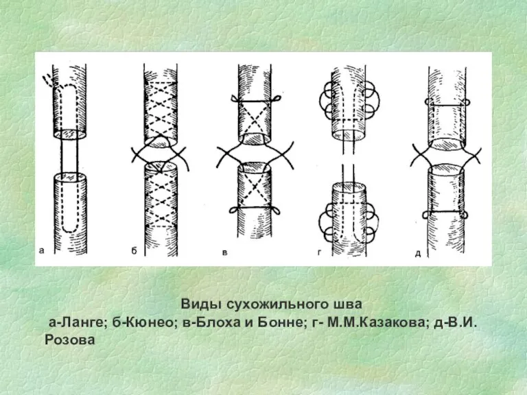 Виды сухожильного шва а-Ланге; б-Кюнео; в-Блоха и Бонне; г- М.М.Казакова; д-В.И.Розова