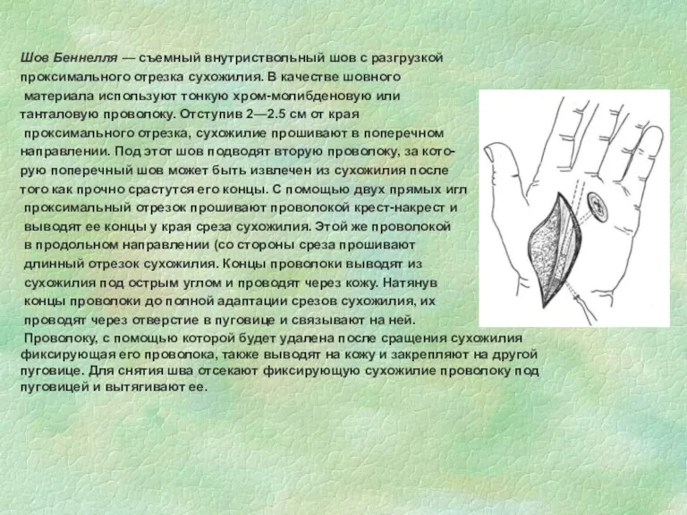 Шов Беннелля — съемный внутриствольный шов с разгрузкой проксимального отрезка