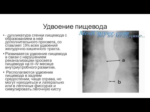 Удвоение пищевода - дупликатура стенки пищевода с образованием в ней