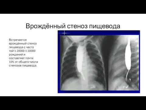 Врождённый стеноз пищевода Встречается врождённый стеноз пищевода с часто­той 1:20000-1:30000