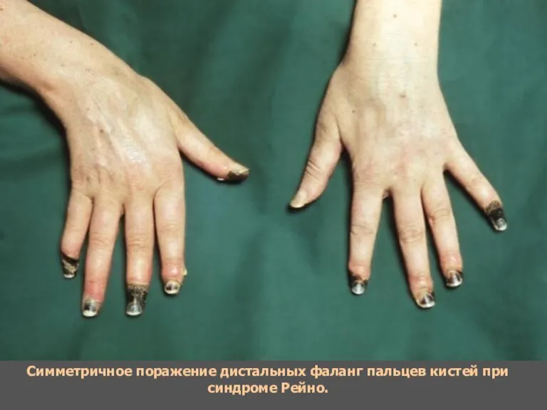 Симметричное поражение дистальных фаланг пальцев кистей при синдроме Рейно.