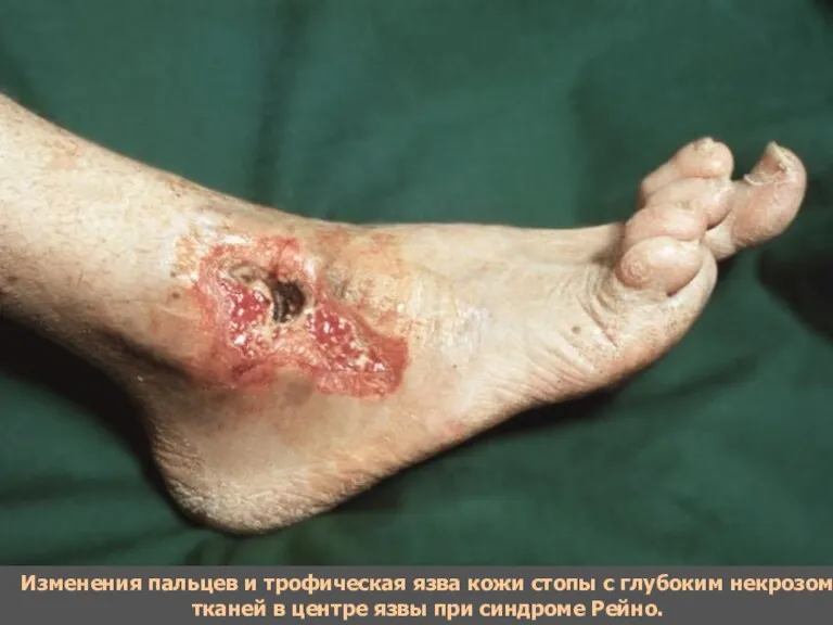 Изменения пальцев и трофическая язва кожи стопы с глубоким некрозом тканей в центре