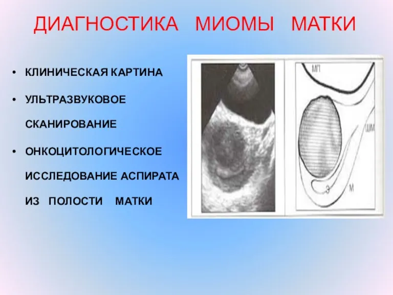 ДИАГНОСТИКА МИОМЫ МАТКИ КЛИНИЧЕСКАЯ КАРТИНА УЛЬТРАЗВУКОВОЕ СКАНИРОВАНИЕ ОНКОЦИТОЛОГИЧЕСКОЕ ИССЛЕДОВАНИЕ АСПИРАТА ИЗ ПОЛОСТИ МАТКИ