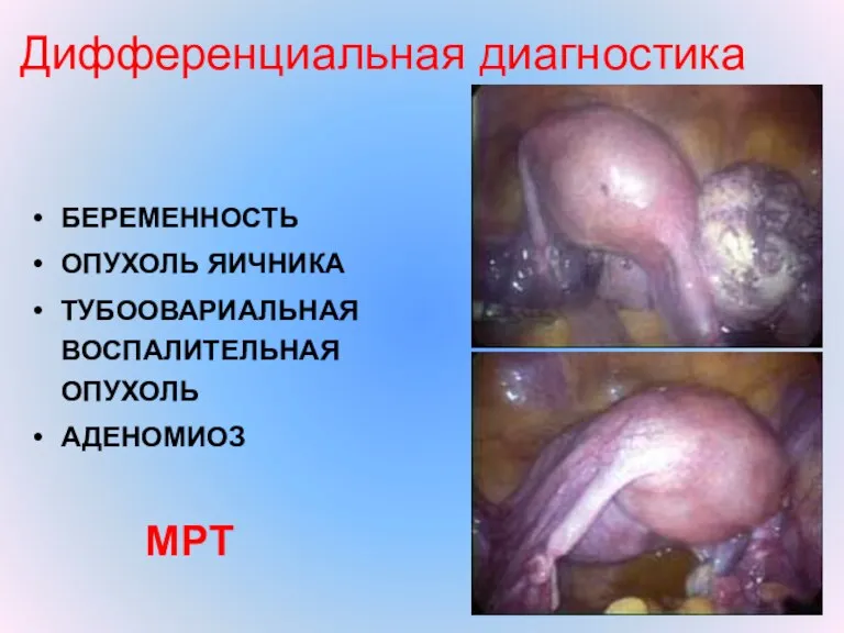 Дифференциальная диагностика БЕРЕМЕННОСТЬ ОПУХОЛЬ ЯИЧНИКА ТУБООВАРИАЛЬНАЯ ВОСПАЛИТЕЛЬНАЯ ОПУХОЛЬ АДЕНОМИОЗ МРТ