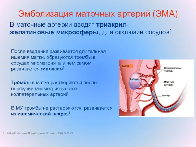 В маточные артерии вводят триакрил-желатиновые микросферы, для окклюзии сосудов1 Miller