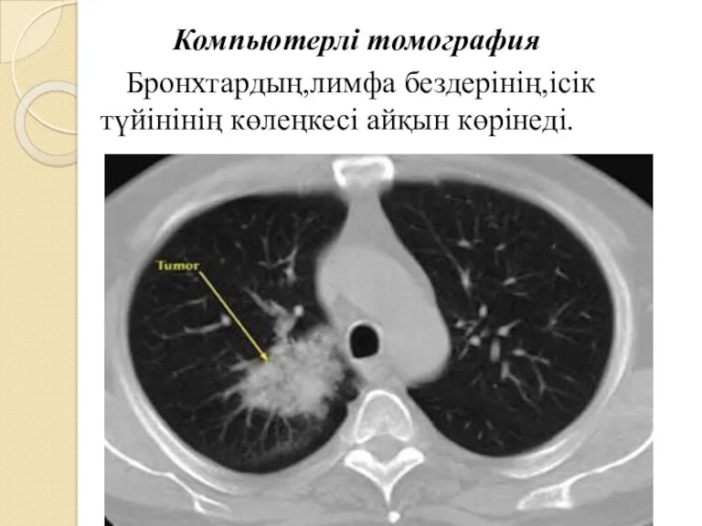 Компьютерлі томография Бронхтардың,лимфа бездерінің,ісік түйінінің көлеңкесі айқын көрінеді.