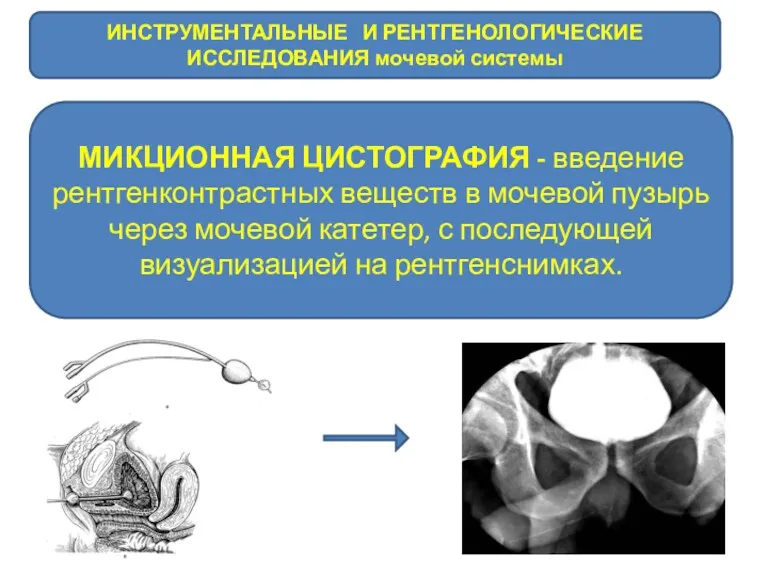 ИНСТРУМЕНТАЛЬНЫЕ И РЕНТГЕНОЛОГИЧЕСКИЕ ИССЛЕДОВАНИЯ мочевой системы МИКЦИОННАЯ ЦИСТОГРАФИЯ - введение