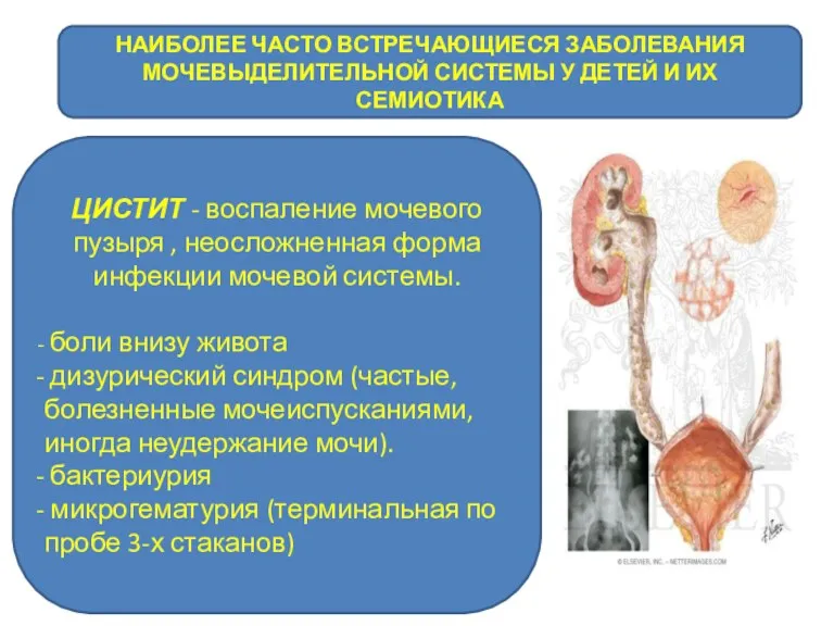 НАИБОЛЕЕ ЧАСТО ВСТРЕЧАЮЩИЕСЯ ЗАБОЛЕВАНИЯ МОЧЕВЫДЕЛИТЕЛЬНОЙ СИСТЕМЫ У ДЕТЕЙ И ИХ