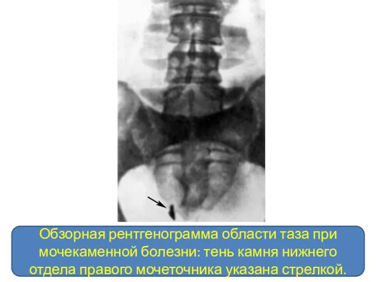 Обзорная рентгенограмма области таза при мочекаменной болезни: тень камня нижнего отдела правого мочеточника указана стрелкой.
