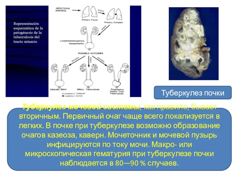 Туберкулез почки Туберкулез мочевой системы, как правило, бывает вторичным. Первичный