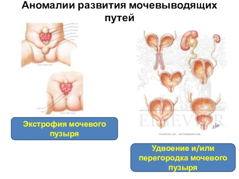 Аномалии развития мочевыводящих путей Экстрофия мочевого пузыря Удвоение и/или перегородка мочевого пузыря