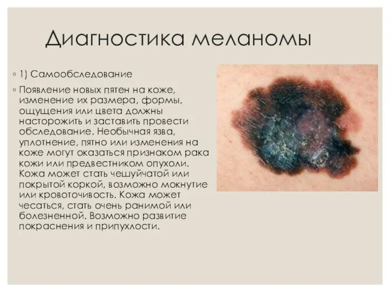 Диагностика меланомы 1) Самообследование Появление новых пятен на коже, изменение