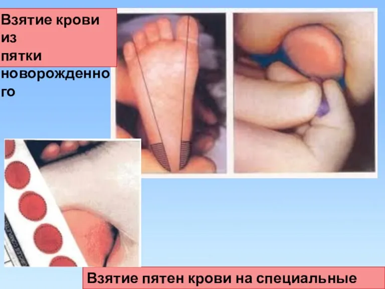 Взятие крови из пятки новорожденного Взятие пятен крови на специальные бланки.