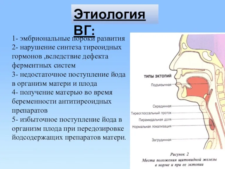 Этиология ВГ: 1- эмбриональные пороки развития 2- нарушение синтеза тиреоидных