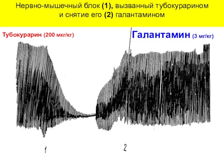 Нервно-мышечный блок (1), вызванный тубокурарином и снятие его (2) галантамином Тубокурарин (200 мкг/кг) Галантамин (3 мг/кг)