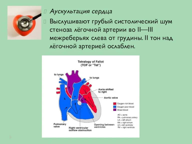 Аускультация сердца Выслушивают грубый систолический шум стеноза лёгочной артерии во