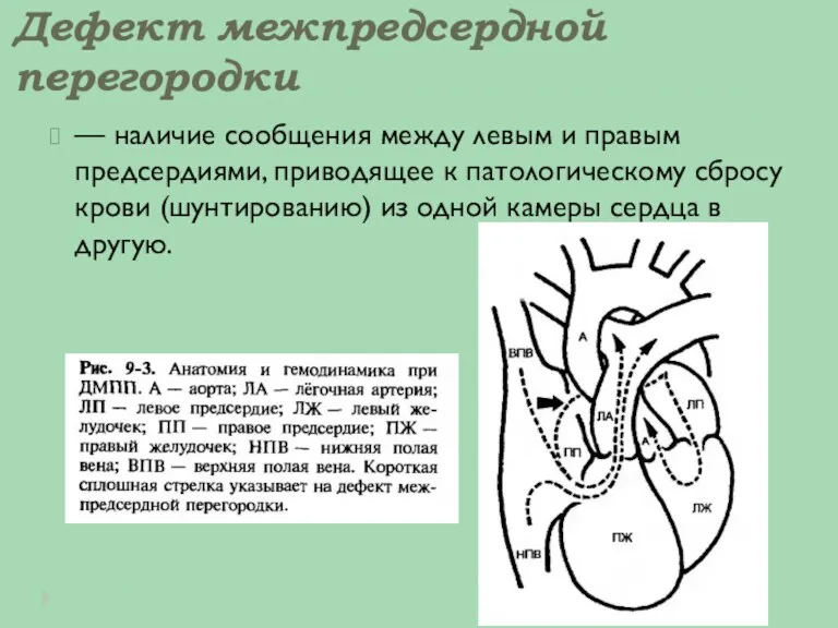 Дефект межпредсердной перегородки — наличие сообщения между левым и правым