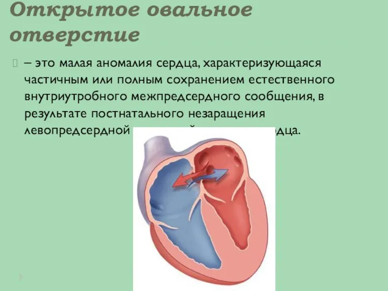 Открытое овальное отверстие – это малая аномалия сердца, характеризующаяся частичным