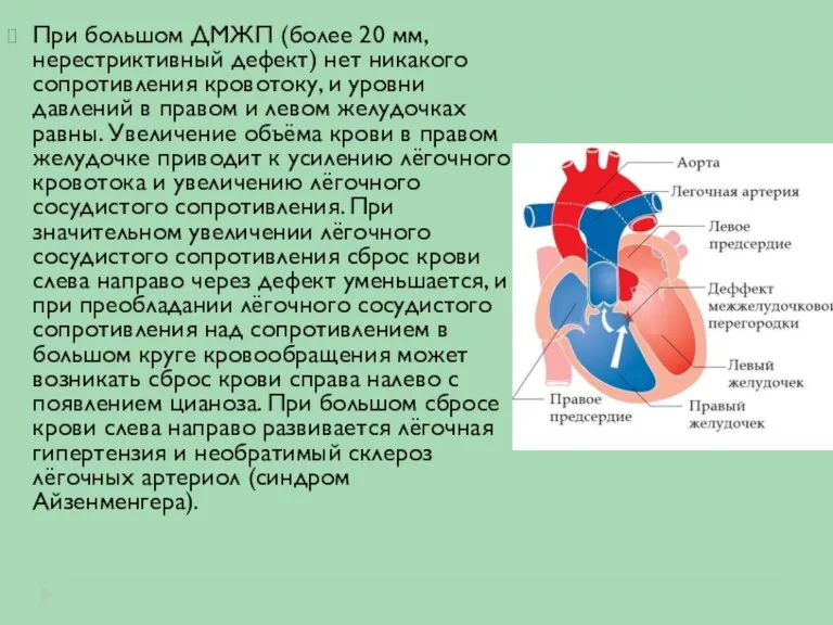 При большом ДМЖП (более 20 мм, нерестриктивный дефект) нет никакого