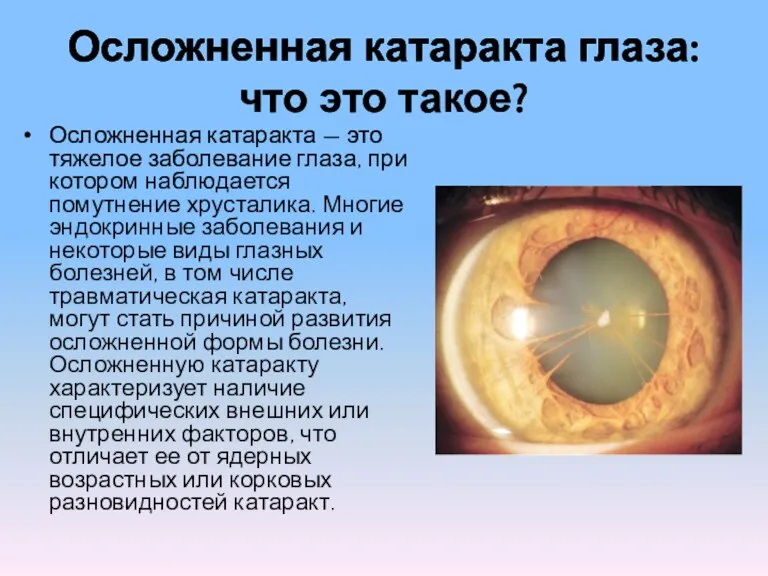 Осложненная катаракта глаза: что это такое? Осложненная катаракта — это тяжелое заболевание глаза,