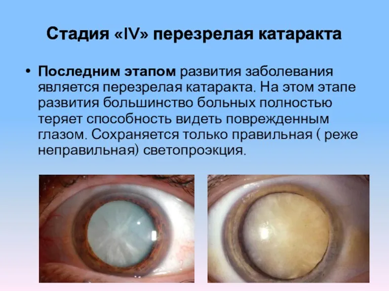 Стадия «IV» перезрелая катаракта Последним этапом развития заболевания является перезрелая катаракта. На этом