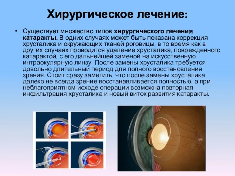 Хирургическое лечение: Существует множество типов хирургического лечения катаракты. В одних случаях может быть