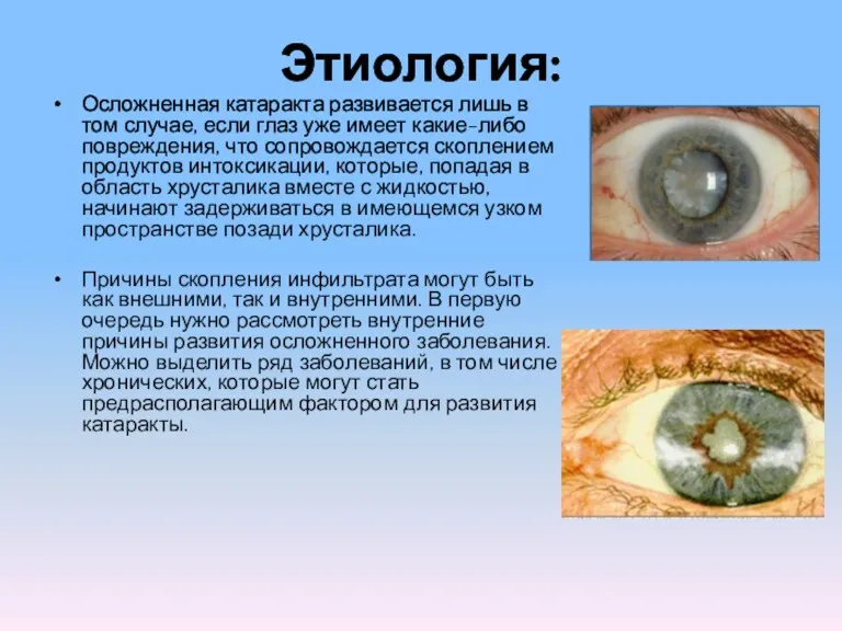 Этиология: Осложненная катаракта развивается лишь в том случае, если глаз уже имеет какие-либо