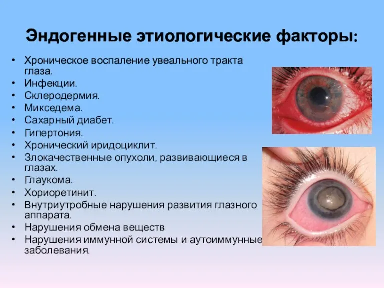 Эндогенные этиологические факторы: Хроническое воспаление увеального тракта глаза. Инфекции. Склеродермия. Микседема. Сахарный диабет.