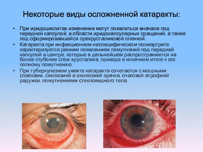 Некоторые виды осложненной катаракты: При иридоциклитах изменения могут появляться вначале под передней капсулой,