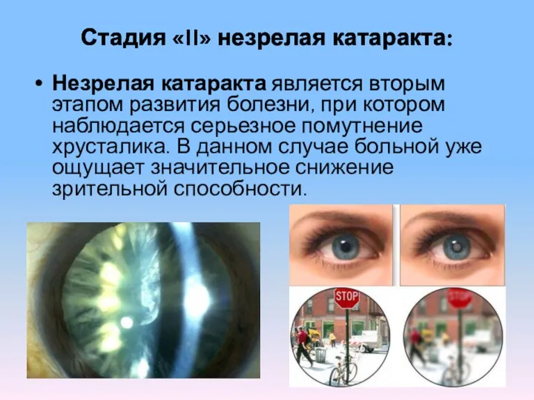 Стадия «II» незрелая катаракта: Незрелая катаракта является вторым этапом развития болезни, при котором