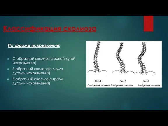 Классификация сколиоза По форме искривления: С-образный сколиоз(с одной дугой искривления) S-образный сколиоз(с двумя