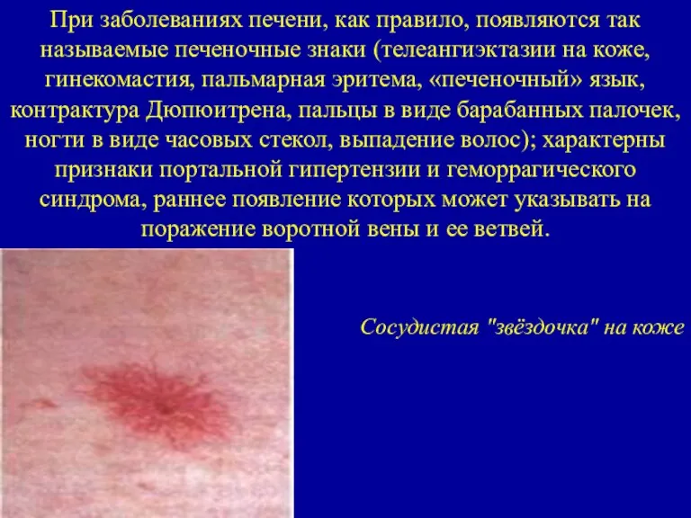 При заболеваниях печени, как правило, появляются так называемые печеночные знаки (телеангиэктазии на коже,