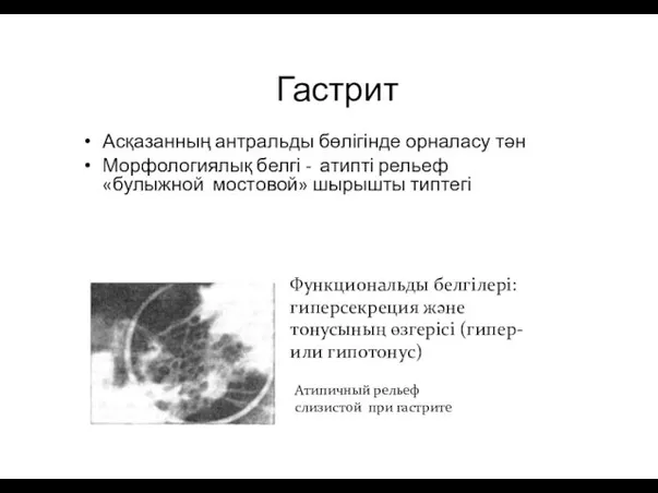 Гастрит Асқазанның антральды бөлігінде орналасу тән Морфологиялық белгі - атипті