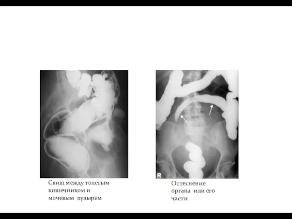 Свищ между толстым кишечником и мочевым пузырем Оттеснение органа или его части