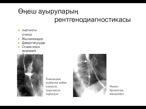 Өңеш ауыруларың рентгенодиагностикасы тыртықты стеноз Жыланкөздер Дивертикулдар Спазм және ахалазия