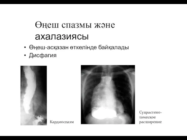 Өңеш спазмы және ахалазиясы Өңеш-асқазан өткелінде байқалады Дисфагия Кардиоспазм Супрастено- тическое расширение