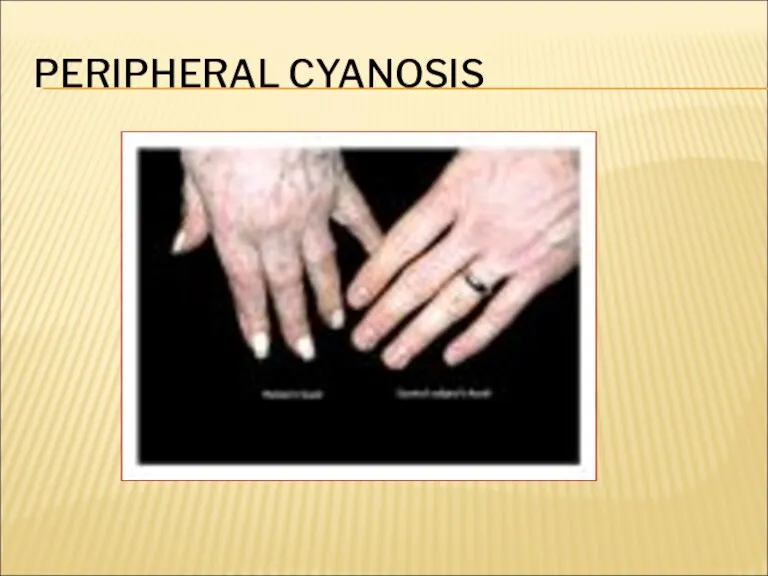 PERIPHERAL CYANOSIS