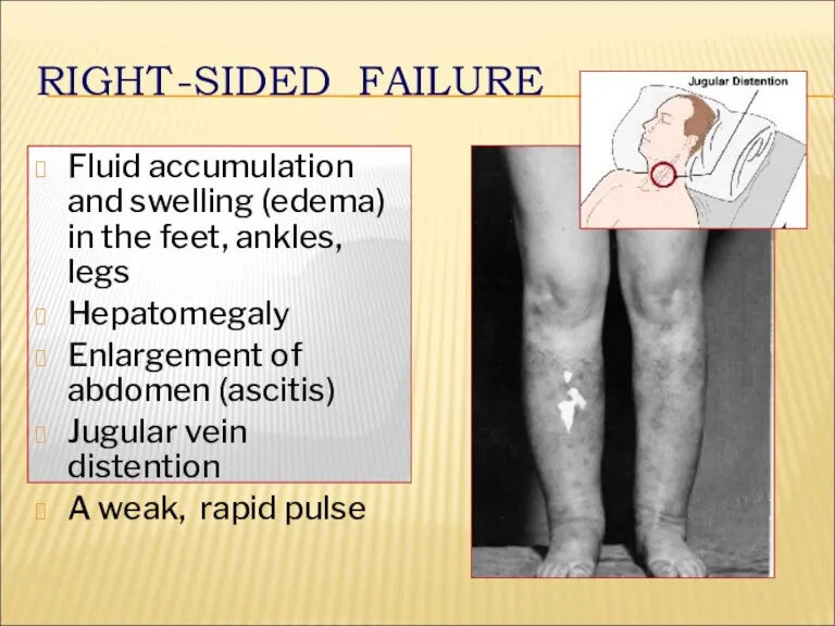 RIGHT-SIDED FAILURE Fluid accumulation and swelling (edema) in the feet,