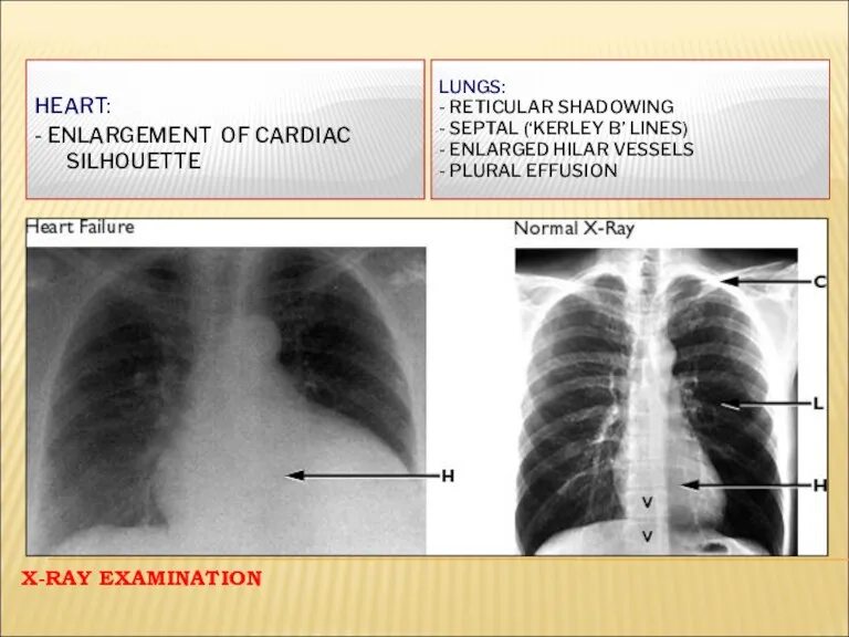 X-RAY EXAMINATION LUNGS: - RETICULAR SHADOWING - SEPTAL (‘KERLEY B’