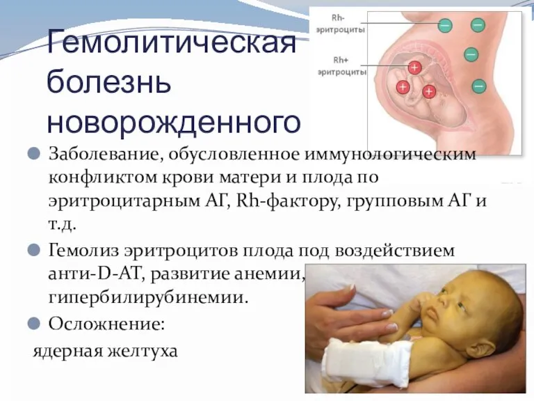Гемолитическая болезнь новорожденного Заболевание, обусловленное иммунологическим конфликтом крови матери и плода по эритроцитарным
