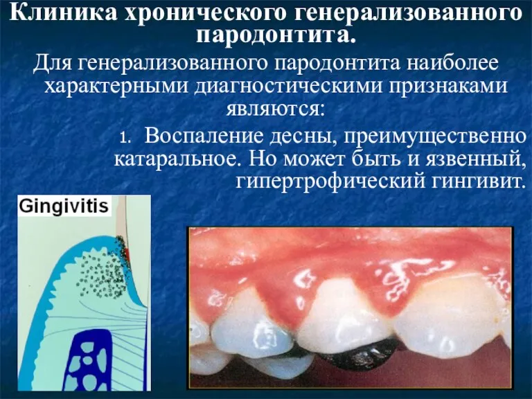 Клиника хронического генерализованного пародонтита. Для генерализованного пародонтита наиболее характерными диагностическими