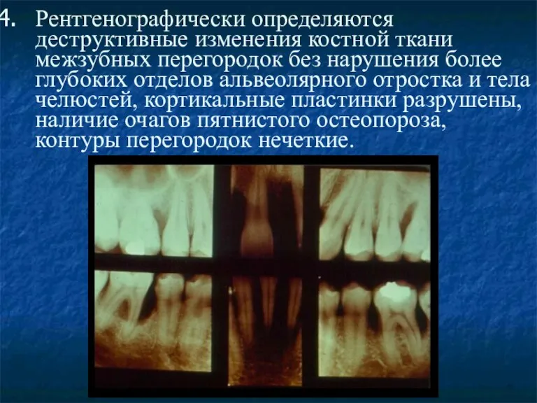 Рентгенографически определяются деструктивные изменения костной ткани межзубных перегородок без нарушения