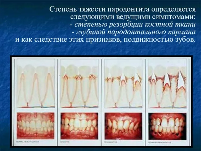 Степень тяжести пародонтита определяется следующими ведущими симптомами: - степенью резорбции