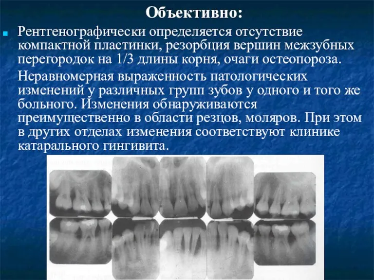 Объективно: Рентгенографически определяется отсутствие компактной пластинки, резорбция вершин межзубных перегородок