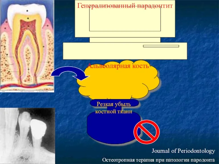 Генерализованный парадонтит Альвеолярная кость Резкая убыль костной ткани Journal of Periodontology Остеотропная терапия при патологии пародонта