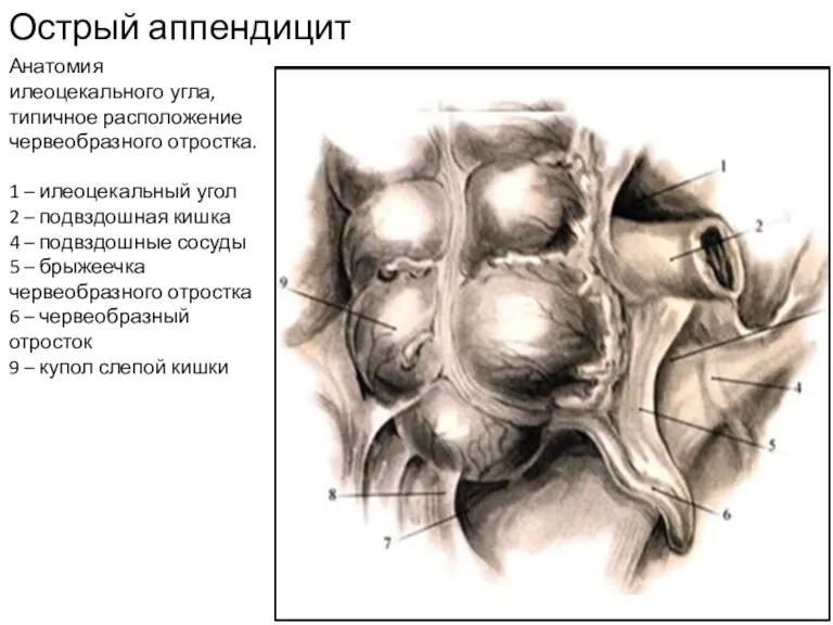 Острый аппендицит Анатомия илеоцекального угла, типичное расположение червеобразного отростка. 1