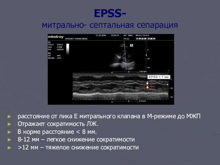 EPSS- митрально- септальная сепарация расстояние от пика Е митрального клапана